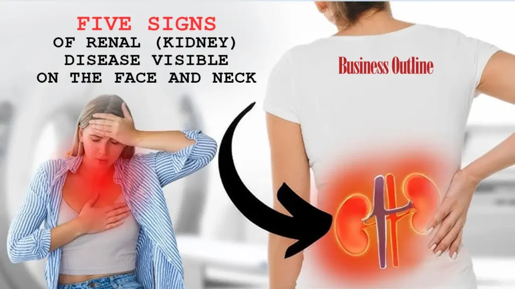 Five Signs of Renal (Kidney) Disease Visible on the Face and Neck